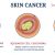 Carcinoma de Células Escamosas da Pele – Sintomas e soluções