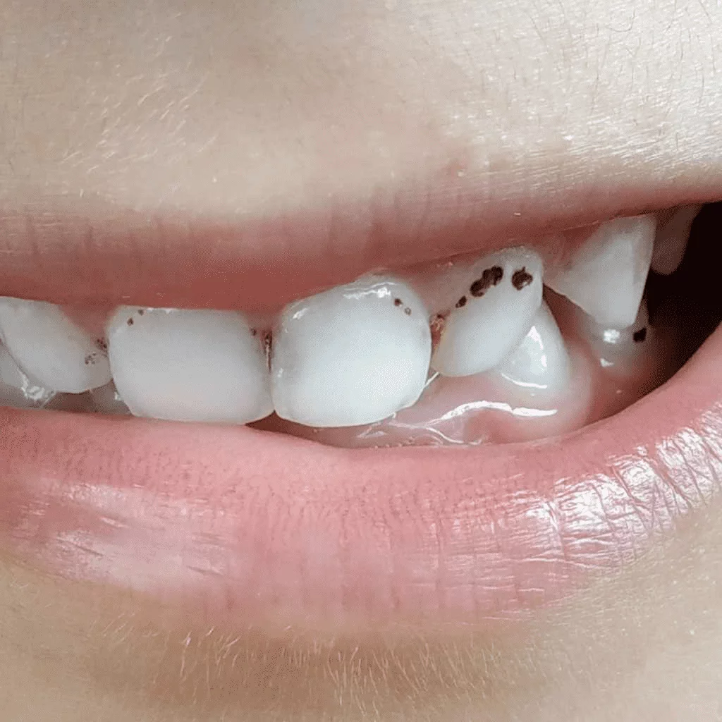 Black dot on tooth