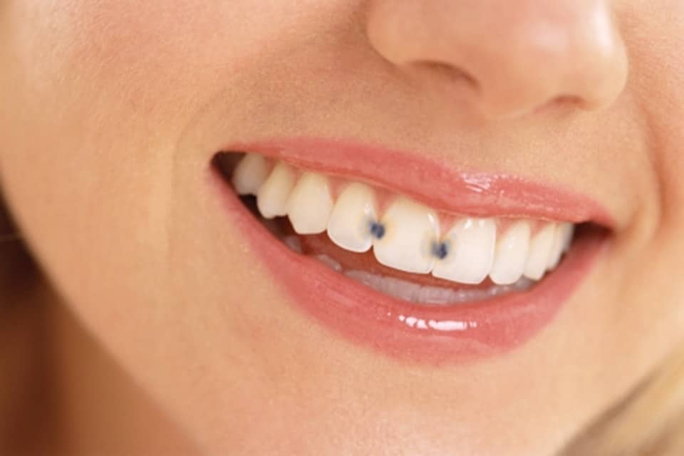 Cavity in between teeth