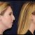Cost of Chin Liposuction: The total expanse on surgery and treatment