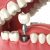 Tooth extraction bone graft healing