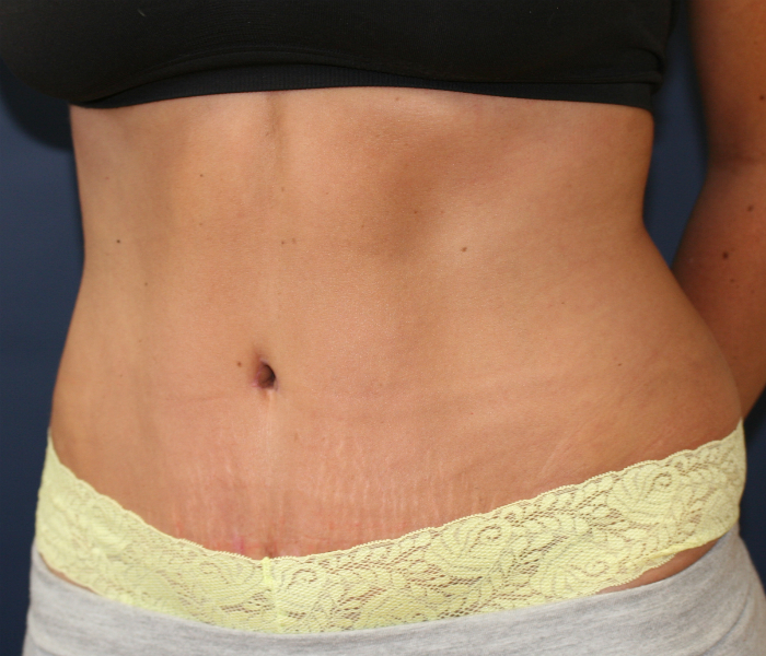 Tummy tuck scar after 5 years